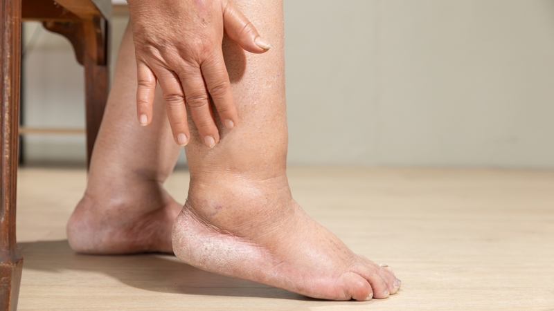 phù nề các chi là dấu hiệu suy thận 